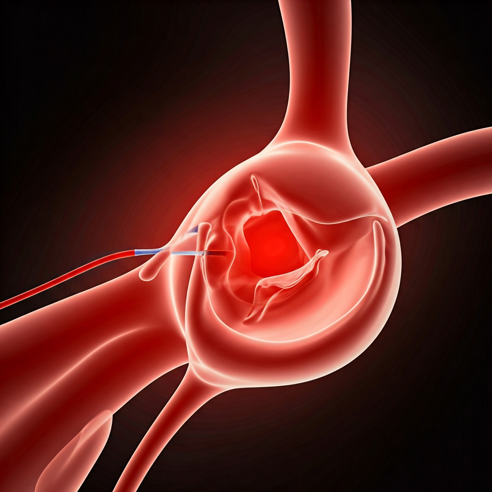 Peripheral Angioplasty